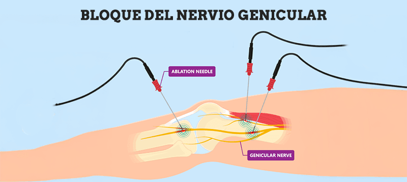 bloqueo del nervio genicular